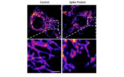 COVID-19 • La piste vasculaire confirmée